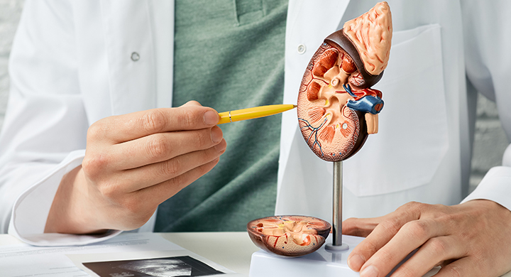 Understanding Kidney Cancer: Causes, Symptoms, and Treatment